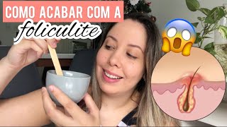 COMO ACABAR COM A FOLICULITE  RECEITA SECRETA [upl. by Alaric230]