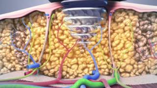 non surgical lipo animation [upl. by Sky]