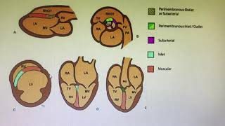 VSD localization on ECHOCARDIOGRAM [upl. by Isyed609]