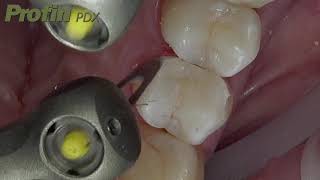 Dentatus Profin PDX Handpiece in action [upl. by Asa]