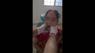 Jaw Joint Dislocation Slip  Manual Reduction Self  at Home Treatment DIY [upl. by Hniv]