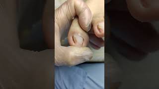 Ep47 Ingrown Toenail Removal Sharing the details of onychomycosis cleaning [upl. by Enoed258]