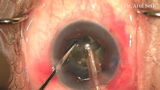 B HEX in Uveitic Cataract  Dr Atul Seth  Eyemax Superspeciality Eye Centre [upl. by Bryce758]