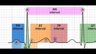 myocardial infarction stemi and nstemi [upl. by Elisabetta349]