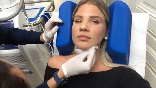 CoolSculpting double menton cryolipolisecryothérapie [upl. by Yvad]