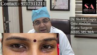 What is Xanthelasma Removal Treatment  Dr Shobhit Gupta Xanthelasma Laser Removal Before and After [upl. by Latsyrc]