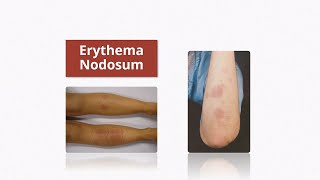 Erythema Nodosum  Causes amp Treatment [upl. by Also]