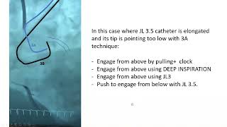 Left coronary engagement simple technique triple maneuver [upl. by Llevart385]