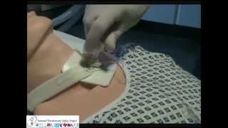 Removal of Tracheostomy Speaking Valves and Inner Tubes [upl. by Tuinenga]