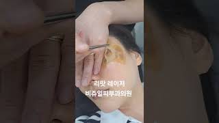 리팟 레이저 다발성 흑자 세종리팟 세종시리팟 reepot lentigo multiplelentigo 청주리팟 공주리팟 대전리팟 오창리팟 오송리팟 부여리팟 [upl. by Etterb119]