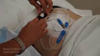 PART 2  How to attach a Baxter transfer set to a Fresenius CAPD catheter [upl. by Aibara879]