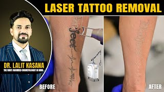 LASER TATTOO REMOVAL  BEFORE amp AFTER [upl. by Wolford]