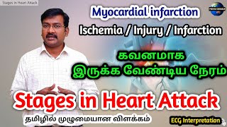 Stages of Heart Attack in tamil  ischemia  injury  infarction  necrosis ECG in MI pstamil [upl. by Orpha]