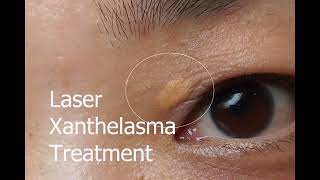 Xanthelasma Removal With TCA [upl. by Nanek767]