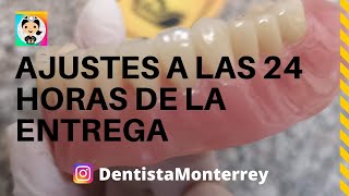 AJUSTES Y Pulido a las 24 Horas 👅PRÓTESIS DENTAL Inferior Parte4 DentaduraCompleta [upl. by Aynotel]