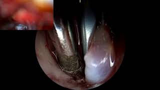 Left MiniPterional Approach for Clipping an Aneurysm [upl. by Nira761]