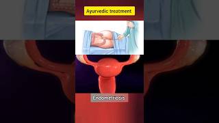 Endometriosis treatment shorts shortvideo viral endometriosis [upl. by Nosremaj]