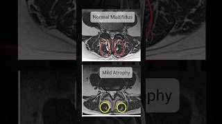 How to check Multifidus muscle in MRI [upl. by Jobe]