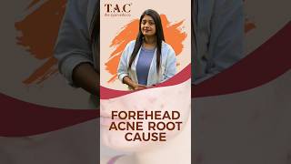 Reasons for Forehead Acne  Acne [upl. by Adnahsat]