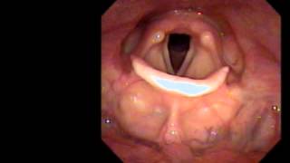 Normal laryngoscopy [upl. by Campbell]