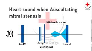 heart sound  Mitral stenosis [upl. by Okubo]