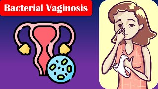 Bacterial Vaginosis  Causes Risk Factors Signs amp Symptoms Diagnosis And Treatment [upl. by Narmis982]