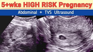 5wks High Risk Pregnancy  Part 1 [upl. by Annayehc]