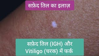 सफ़ेद तिल का इलाज़  Idiopathic Guttate Hypomelanosis IGH  सफ़ेद तिल और चरक vitiligo vitiligocure [upl. by Iolande]