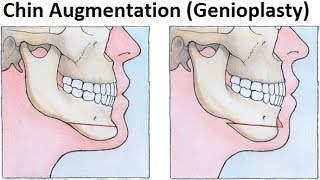 Treatment of Retruded JawsMandible Using GenioplastyMentoplastyChin Augmentation by Dr Mike Mew [upl. by Brodench622]