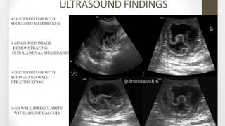 Gangrenous cholecystitis  A rare Entity [upl. by Enimaj]