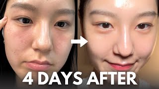 How I repair my skin barrier in 4 days at home with affordable skincare routine [upl. by Eilojne]