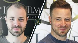 Hair Transplant Before and After  Hair Transplant Results [upl. by Sherrie]