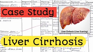 Case Study on Liver Cirrhosis  Case Presentation Nursing Care Plan nursingcriteria [upl. by Kilby]