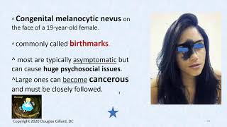 Dermatology Wk10Fall20 Congenital and Acquired Melanocytic Nevi Moles [upl. by Alael]