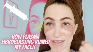 Did Plasma Fibroblast Ruin My face [upl. by Eirene]