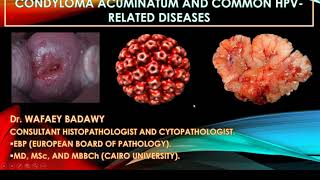 CONDYLOMA ACUMINATUM AND COMMON HPV RELATED LESIONS BY Dr WAFAEY BADAWY [upl. by Idham]