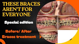 Transform your smile Before and after braces  Orthodontics treatment guide [upl. by Grizel18]