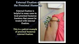 External Fixation Of The Proximal Humerus  Everything You Need To Know  Dr Nabil Ebraheim [upl. by Pall]