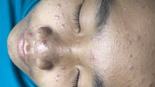 ACNE TREATMENT VU QUYNH MI  Blackheads Chin amp Nose Of Man 2024 EX [upl. by Aetnuahs75]