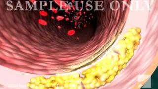 Atherosclerosis [upl. by Cheston897]