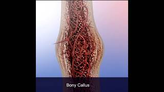 Bone Fractures Proper Healing [upl. by Casie]