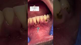 Gingivitis periodontists How old Are You  Your GUM 😦😦😦 [upl. by Dow]