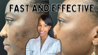 Do Chemical Peels Really Make A Difference [upl. by Deeanne]