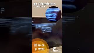 ELECTROLISIS PERCUTANEA COLOMBIA [upl. by Griffiths]