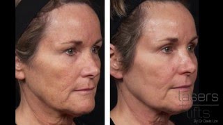 How long does it take to heal from CO2 laser resurfacing Fractional [upl. by Ury986]