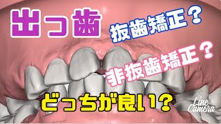 出っ歯を引っ込める 抜歯矯正か？非抜歯矯正か？ 白いワイヤー矯正 マウスピース矯正？大宮 鈴木歯科医院 矯正歯科 [upl. by Outhe721]