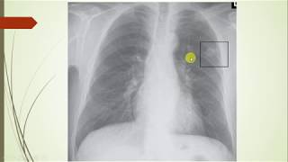 Histoplasmosis a clinical case based review geography symptoms differential diagnosis treatment [upl. by Eliseo881]