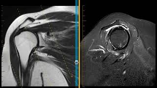 Shoulder impingement with rotator cuff tendinopathy and labral tear [upl. by Rodrique]