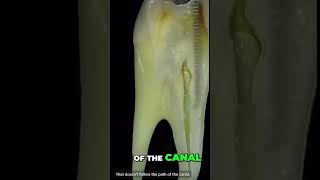 How to manage a ledge endodontics ledge rootcanal dentistry dentist [upl. by Meggy]