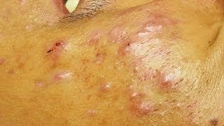 Enlever les points noirs les microkystes et un acné kystique a cystic acne [upl. by Oinegue]